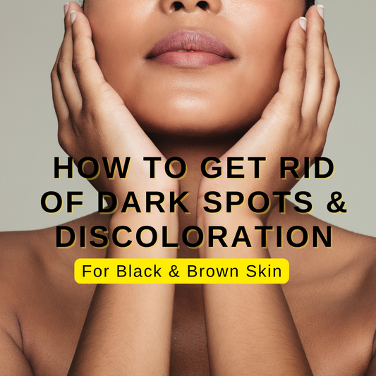 4 tips to Eliminate hyper-pigmentation, discoloration & dark spots
